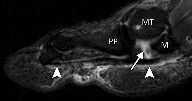 Turf toe in a 28-year-old professional American football player. Arrowheads = FHL, MT = first metatarsal. (a) Sagittal PDW FS image of the right first MTPJ shows complete tearing of the medial SPL (arrow). Additional high-grade tearing of the lateral SPL was apparent (not shown). PP = first proximal phalanx. (b, c) Coronal PDW FS images of the lateral (L) and medial (M) sesamoids (b) and just distal to the sesamoids (c) show the medial SPL tear extending into the ISL (★) and central plantar plate (*). Partial tearing of the medial MTSL (dotted arrow) is also seen. (d) Lateral dynamic dorsiflexed radiograph of both feet shows increased proximal migration of the right medial sesamoid compared to the left medial sesamoid. The medial sesamoids and proximal phalanges are outlined (dashed lines).