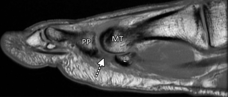 Turf toe in a 24-year-old professional football player. (a, b) Sagittal PDW (a) and sagittal PDW FS (b) images show complete tearing of the lateral SPL (arrow). Complete tearing of the medial SPL was also present (not shown). Slight proximal migration of the lateral (L) and medial (M) sesamoids is noted on the static MR images (a–c). MT = first metatarsal, PP = first proximal phalanx. (c) Axial (long-axis) PDW FS image shows marked edema at the plantar plate complex and lateral (dotted arrow) and medial (solid arrow) SPLs. (d) Lateral dynamic dorsiflexed radiograph of both feet shows proximal medial and lateral sesamoid migration in the right foot because of SPL tearing.