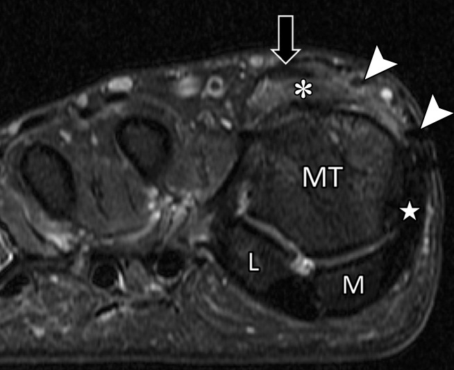 Treatment for hallux valgus. Axial PDW (a), coronal T2-weighted FS (b), and sagittal PDW (c) images in a 37-year-old man with reduced extension at the right first MTPJ who had hallux valgus corrective surgery 17 years earlier and hardware removed 1 year before. Postoperative changes and metallic artifacts are seen at the first metatarsal (MT) and proximal phalanx (PP) because of osteotomies. There is thickening of the medial collateral ligament (white arrow) and MTSL (☆) with postsurgical fibrosis appearing as low signal intensity along an attenuated medial sagittal band (arrowheads). Lateralization and tendinosis of the extensor tendons (black arrow) with underlying synovitis, fibrosis, and capsulitis (*) lead to reduced extension. The medial SPL (dotted arrow) shows only mild degeneration. L = lateral sesamoid, M = medial sesamoid.