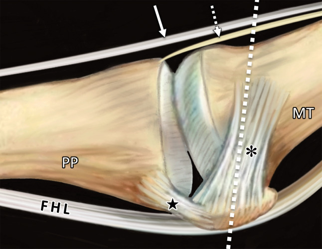 First MTPJ anatomy. Sagittal (a) and coronal cross-sectional (b) drawings (plane in b represented by the dotted line in a) show how the medial SPL (★), lateral SPL (not shown), and lateral (#) and medial (*) MTSLs secure the lateral (L) and medial (M) sesamoids. These ligaments form a plantar plate complex with the joint capsule, ISL, and musculotendinous structures. At the dorsal first MTPJ, the EHB (dotted arrow) attaches to the proximal phalanx (PP) and lies deep and slightly lateral to the EHL (solid arrow). The first metatarsal crest (arrowhead in b) is shown between the grooved sesamoid facets. FHL = flexor hallucis longus, IS = intersesamoid ligament, MT = metatarsal.