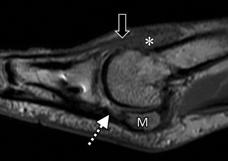 Treatment for hallux valgus. Axial PDW (a), coronal T2-weighted FS (b), and sagittal PDW (c) images in a 37-year-old man with reduced extension at the right first MTPJ who had hallux valgus corrective surgery 17 years earlier and hardware removed 1 year before. Postoperative changes and metallic artifacts are seen at the first metatarsal (MT) and proximal phalanx (PP) because of osteotomies. There is thickening of the medial collateral ligament (white arrow) and MTSL (☆) with postsurgical fibrosis appearing as low signal intensity along an attenuated medial sagittal band (arrowheads). Lateralization and tendinosis of the extensor tendons (black arrow) with underlying synovitis, fibrosis, and capsulitis (*) lead to reduced extension. The medial SPL (dotted arrow) shows only mild degeneration. L = lateral sesamoid, M = medial sesamoid.