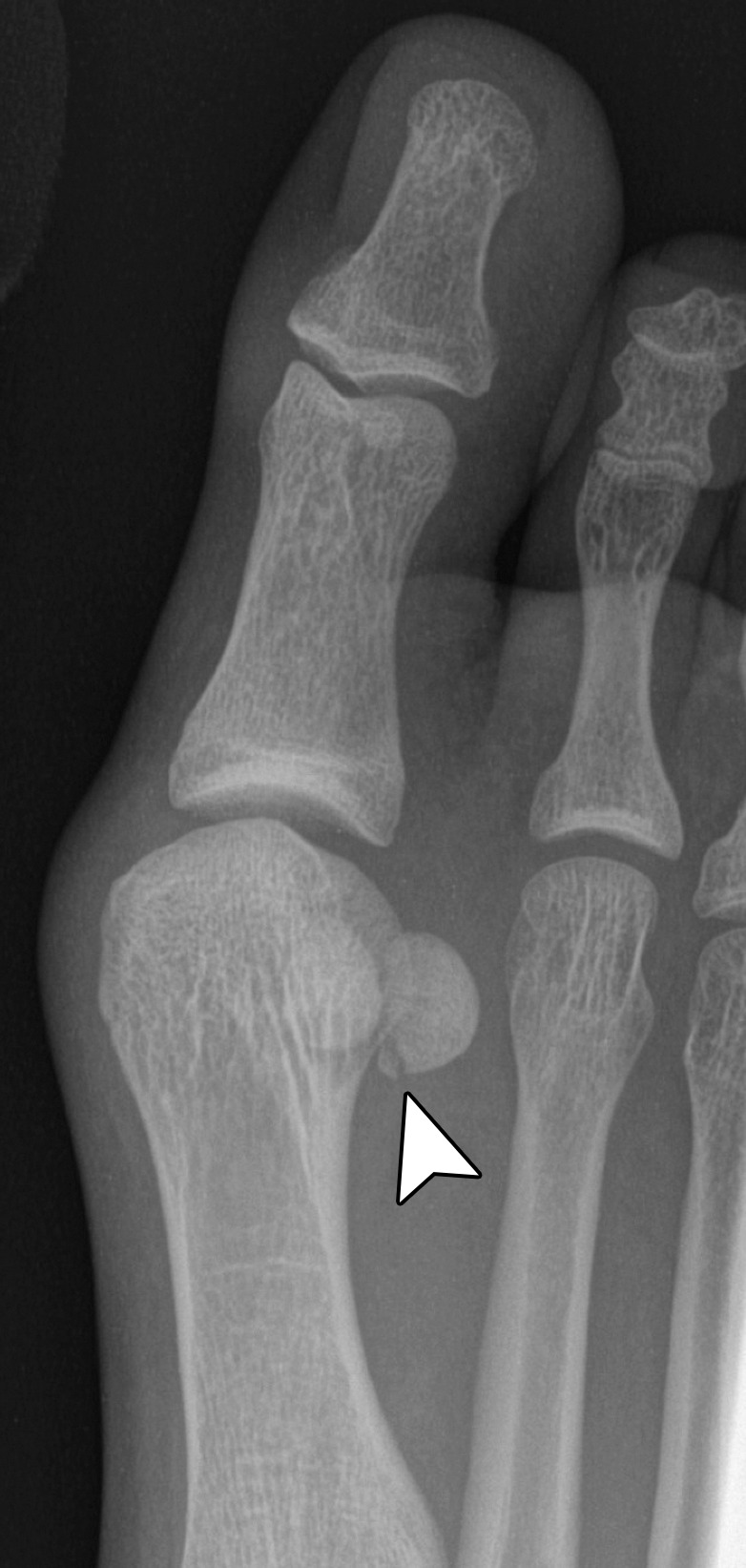 Sesamoid fracture. (a, b) Medial sesamoid fracture in a 32-year-old man after a fall. Axial T2-weighted FS (a) and sagittal PDW (b) images show an irregular cleft through the medial sesamoid with edema at the bony fragments and mild displacement likely caused by a fracture (solid white arrow). An intact medial SPL is apparent (dotted arrow). Differentiating a bipartite sesamoid from a fracture can be challenging. Irregular margins, displacement of the bony components, and a clear history of trauma are more suggestive of a fracture. Radiographs can be useful in assessment and follow-up, but radiographs were not available in this patient. L = lateral sesamoid. (c) Dorsoplantar radiograph in a 49-year-old woman with trauma to the medial sesamoid shows a cleft at the medial sesamoid with slightly irregular margins and no rounded waist (dashed circle). These imaging features are more suggestive of a fracture. (d, e) Dorsoplantar radiograph (d) obtained at 1-year follow-up and axial CT image (e) show interval osseous bridging due to healing. (f) Medial oblique radiograph in a 24-year-old woman shows an irregular fracture of the proximal lateral sesamoid (arrowhead) associated with a dislocation at the first MTPJ due to a motor vehicle accident.