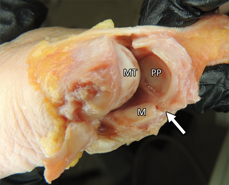 First MTPJ anatomy. (a) Drawing depicts a view from below the first MTPJ musculotendinous structures. Laterally, the oblique (ADo) and transverse (ADt) heads of the adductor hallucis provide resistance to medial displacement. Medially, the abductor hallucis tendon (AB) inserts at the medial sesamoid (M) and medial capsuloligamentous structures, preventing hallux valgus. The lateral (FHBl) and medial (FHBm) heads of the FHB insert at the respective sesamoids, preventing distal sesamoid migration. Inset in a shows the MTPJ with the FHL and tendons removed. IS = intersesamoid ligament. (b, c) Gross anatomy of a cadaveric first MTPJ specimen (b) is also shown with the medial structures dissected and then with plantar disarticulation, with the plantar plate complex (c) viewed from the dorsal aspect. Paired SPLs (☆) and the medial SPL (arrow in b) are continuous with the capsule and fibrocartilaginous pad (*), preventing proximal sesamoid migration. The ISL (dotted line in c) prevents sesamoid splaying. Chondral defects are noted at the metatarsal head (arrowheads in c). L = lateral sesamoid, MT = metatarsal, PP = proximal phalanx.