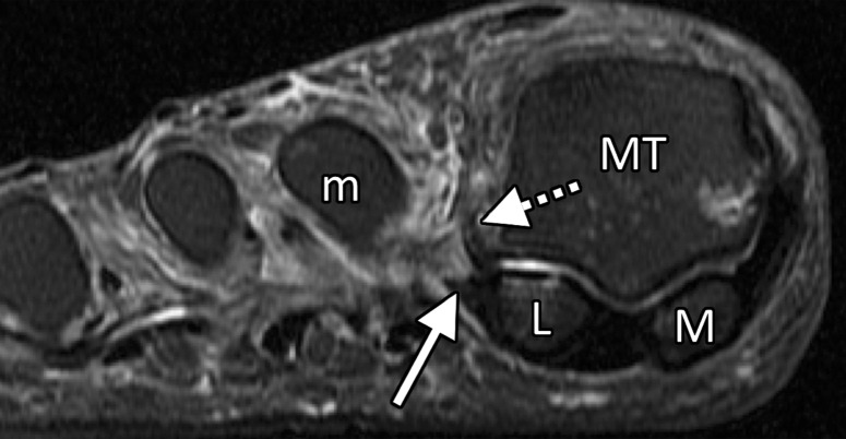 Lateral MTSL tear and adductor hallucis tendinosis and atrophy in a 69-year-old woman with hallux valgus and persistent foot pain. Coronal PDW (a, c) and T2-weighted FS (b) images show first MTPJ degenerative changes with chondral loss and subchondral edema most apparent at the lateral sesamoid (L) and metatarsal articulation. There is partial tearing of the lateral MTSL (dashed circle) and lateral collateral ligament (black arrow). More proximally in b, there is predislocation syndrome with edema surrounding the distal second (m) and third metatarsal shafts and MTPJs due to capsulitis. Tendinosis of the transverse (solid white arrow) and oblique (dotted arrow) heads of the adductor hallucis is apparent with fatty muscle atrophy (arrowheads) seen proximally in c. f = flexor hallucis longus tendon, M = medial sesamoid, MT = metatarsal.