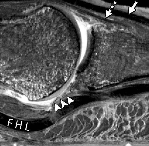 First MTPJ anatomy in a cadaveric specimen. Axial (a), central sagittal (b), and medial sagittal (c) gradient-echo images (5000/10) show how the lateral (L) and medial (M) sesamoids are connected by the ISL (☆). A fibrocartilaginous pad (arrowheads) is seen distal to the ISL, which merges with the medial SPL (black arrow) and lateral SPL (not shown). Dorsally, the EHB tendon (dotted arrow) attaches to the proximal phalanx and lies deep to the EHL tendon (white arrow).