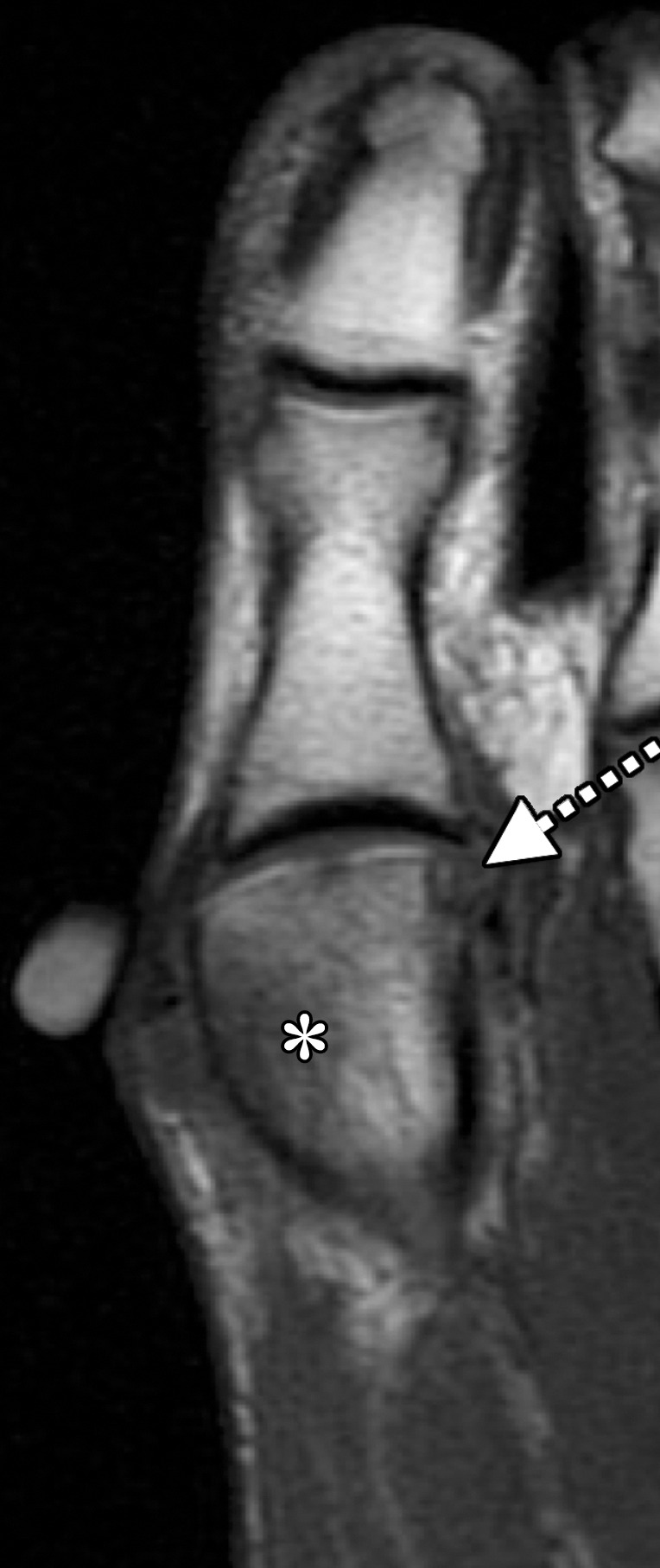 Rheumatoid arthritis at the first MTPJ in a 32-year-old woman with known rheumatoid arthritis and first toe pain and stiffness. Coronal T2-weighted FS (a) and axial T1-weighted (b) images show prominent bone marrow edema at the first MTPJ, mainly involving the metatarsal head (*) as well as the medial (M) and lateral (L) sesamoids. These imaging findings are associated with joint effusion and synovial hypertrophy (solid arrows). An erosion is seen along the lateral aspect of the metatarsal head (dotted arrow). The constellation of findings suggests an inflammatory arthropathy.