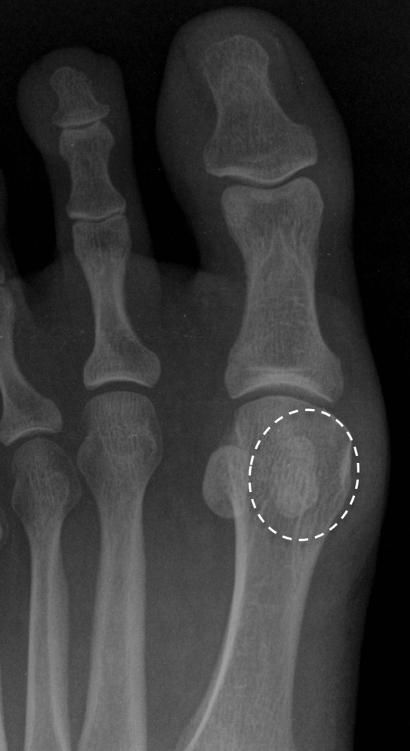 Sesamoid fracture. (a, b) Medial sesamoid fracture in a 32-year-old man after a fall. Axial T2-weighted FS (a) and sagittal PDW (b) images show an irregular cleft through the medial sesamoid with edema at the bony fragments and mild displacement likely caused by a fracture (solid white arrow). An intact medial SPL is apparent (dotted arrow). Differentiating a bipartite sesamoid from a fracture can be challenging. Irregular margins, displacement of the bony components, and a clear history of trauma are more suggestive of a fracture. Radiographs can be useful in assessment and follow-up, but radiographs were not available in this patient. L = lateral sesamoid. (c) Dorsoplantar radiograph in a 49-year-old woman with trauma to the medial sesamoid shows a cleft at the medial sesamoid with slightly irregular margins and no rounded waist (dashed circle). These imaging features are more suggestive of a fracture. (d, e) Dorsoplantar radiograph (d) obtained at 1-year follow-up and axial CT image (e) show interval osseous bridging due to healing. (f) Medial oblique radiograph in a 24-year-old woman shows an irregular fracture of the proximal lateral sesamoid (arrowhead) associated with a dislocation at the first MTPJ due to a motor vehicle accident.