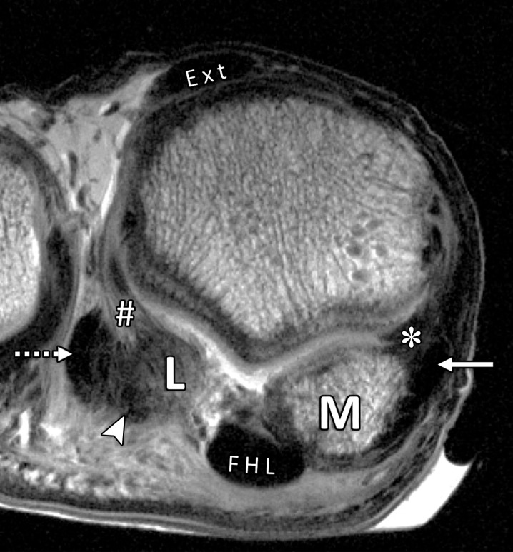 Normal anatomy of the first MTSLs. Coronal (a) and lateral sagittal (b) PDW images (2000/35) depict how the lateral (#) and medial (*) MTSLs secure the lateral (L) and medial (M) sesamoids. The MTSLs are components of the plantar plate complex and attach to the sesamoids in close relation to the FHB tendons. The insertion of the lateral head of the FHB tendon can be seen (arrowhead). The lateral MTSL inserts adjacent to the conjoint adductor hallucis tendon (dotted arrow), which resists varus stress. The medial MTSL inserts adjacent to the abductor hallucis tendon (solid arrow), which resists valgus stress. The rhomboid lateral MTSL (white dotted line in b) blends with the capsule and lateral SPL (☆). Ext = extensor tendons.