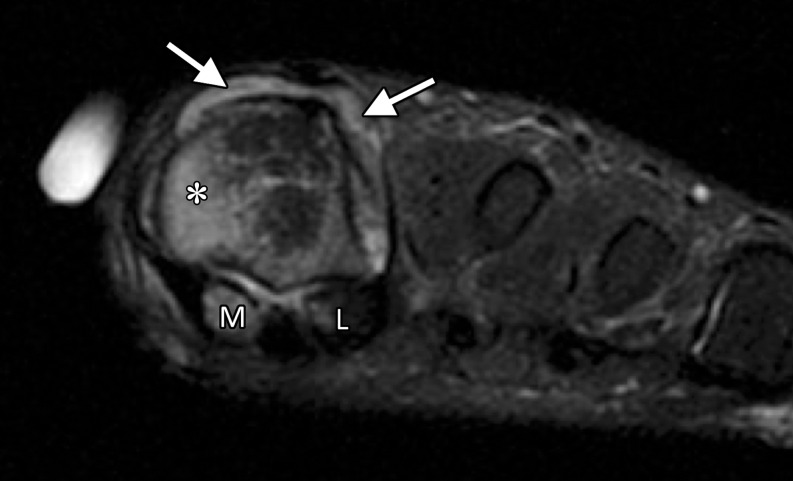 Rheumatoid arthritis at the first MTPJ in a 32-year-old woman with known rheumatoid arthritis and first toe pain and stiffness. Coronal T2-weighted FS (a) and axial T1-weighted (b) images show prominent bone marrow edema at the first MTPJ, mainly involving the metatarsal head (*) as well as the medial (M) and lateral (L) sesamoids. These imaging findings are associated with joint effusion and synovial hypertrophy (solid arrows). An erosion is seen along the lateral aspect of the metatarsal head (dotted arrow). The constellation of findings suggests an inflammatory arthropathy.