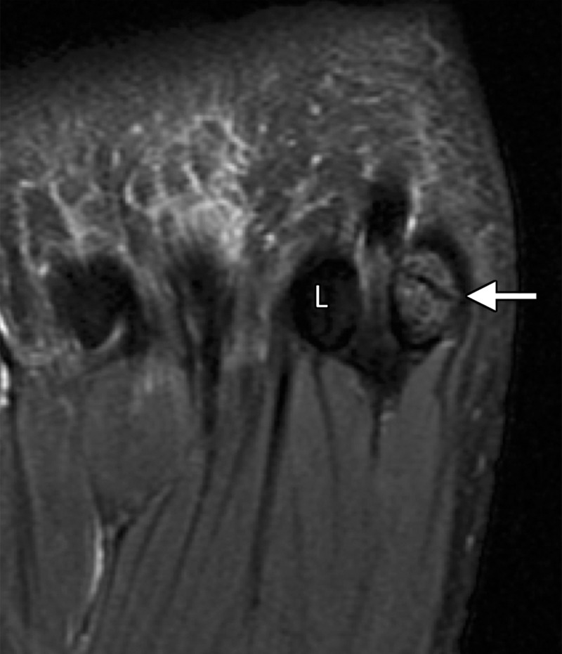 Bipartite sesamoiditis. (a–c) Axial (a) and sagittal T2-weighted FS (b) and sagittal (c) PDW images show medial sesamoiditis in a 24-year-old woman with pain at the plantar aspect of the right first MTPJ. There is a bifid appearance of the medial sesamoid with marrow edema (solid arrow in a and b) at both components. Smooth corticated margins and the presence of a waist at the superior margin of the sesamoid (arrow in c) are more suggestive of bipartite sesamoiditis rather than a fracture. Partial tearing of the medial SPL is also seen (dotted arrow). Radiographs were not available in this patient but are useful for assessment and follow-up. L = lateral sesamoid. (d, e) Dorsoplantar (d) and lateral (e) radiographs in a 15-year-old patient with plantar trauma show separation of two components at the medial sesamoid (dashed circles). This was a challenging case, with the proximal rounded margins of the distal component (arrowhead) suggestive of diastasis of a bipartite sesamoid rather than a fracture. Despite the challenges in differentiating the two conditions, fracture and diastasis are treated similarly with initial conservative management.