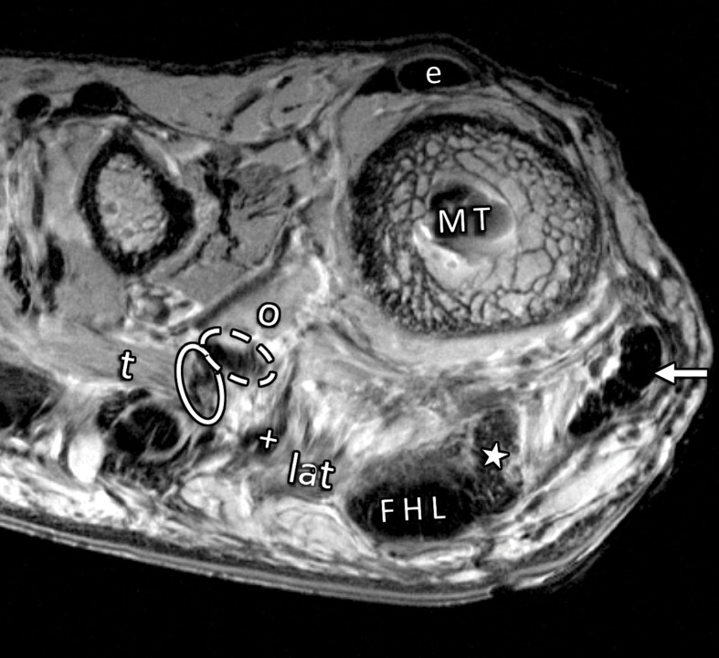 Musculotendinous structures of the first MTPJ. Coronal PDW images (2000/35) of the metatarsosesamoid joint (a) and the distal first metatarsal (MT) (b) depict the attachment of the adductor (dotted arrow) and abductor (solid arrow) hallucis tendons to the lateral (L) and medial (M) sesamoids. These tendons insert in close relation to the lateral (#) and medial (*) MTSLs and the lateral (+ = tendon, lat = muscle belly) and medial (☆) heads of the FHB. The adductor hallucis conjoint tendon is formed from the transverse (t = muscle, solid oval = tendon) and oblique (o = muscle, dashed oval = tendon) heads. Dorsally, the extensor tendons (e) can be seen secured by the lateral and medial sagittal bands (arrowheads).