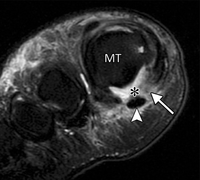 Turf toe in a 28-year-old professional American football player. Arrowheads = FHL, MT = first metatarsal. (a) Sagittal PDW FS image of the right first MTPJ shows complete tearing of the medial SPL (arrow). Additional high-grade tearing of the lateral SPL was apparent (not shown). PP = first proximal phalanx. (b, c) Coronal PDW FS images of the lateral (L) and medial (M) sesamoids (b) and just distal to the sesamoids (c) show the medial SPL tear extending into the ISL (★) and central plantar plate (*). Partial tearing of the medial MTSL (dotted arrow) is also seen. (d) Lateral dynamic dorsiflexed radiograph of both feet shows increased proximal migration of the right medial sesamoid compared to the left medial sesamoid. The medial sesamoids and proximal phalanges are outlined (dashed lines).