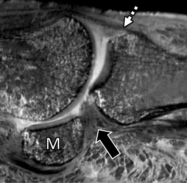 First MTPJ anatomy in a cadaveric specimen. Axial (a), central sagittal (b), and medial sagittal (c) gradient-echo images (5000/10) show how the lateral (L) and medial (M) sesamoids are connected by the ISL (☆). A fibrocartilaginous pad (arrowheads) is seen distal to the ISL, which merges with the medial SPL (black arrow) and lateral SPL (not shown). Dorsally, the EHB tendon (dotted arrow) attaches to the proximal phalanx and lies deep to the EHL tendon (white arrow).