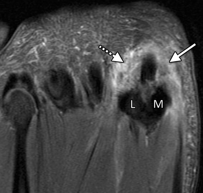 Turf toe in a 24-year-old professional football player. (a, b) Sagittal PDW (a) and sagittal PDW FS (b) images show complete tearing of the lateral SPL (arrow). Complete tearing of the medial SPL was also present (not shown). Slight proximal migration of the lateral (L) and medial (M) sesamoids is noted on the static MR images (a–c). MT = first metatarsal, PP = first proximal phalanx. (c) Axial (long-axis) PDW FS image shows marked edema at the plantar plate complex and lateral (dotted arrow) and medial (solid arrow) SPLs. (d) Lateral dynamic dorsiflexed radiograph of both feet shows proximal medial and lateral sesamoid migration in the right foot because of SPL tearing.