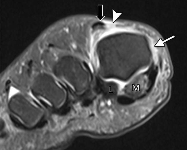 Skimboarder toe. Coronal T1-weighted (a) and T2-weighted FS (b) images show high-grade tearing of the medial sagittal band (arrowhead) and lateral subluxation of the extensor tendons (black arrow) due to forced hyperextension. Tearing of the medial capsular structures and collateral ligament is noted (white arrow) with additional medial sesamoiditis or degeneration. Skimboarders use their great toe for traction when mounting their waxed boards. The board can slip posteriorly, leading to forced first MTPJ hyperextension. L = lateral, M = medial.