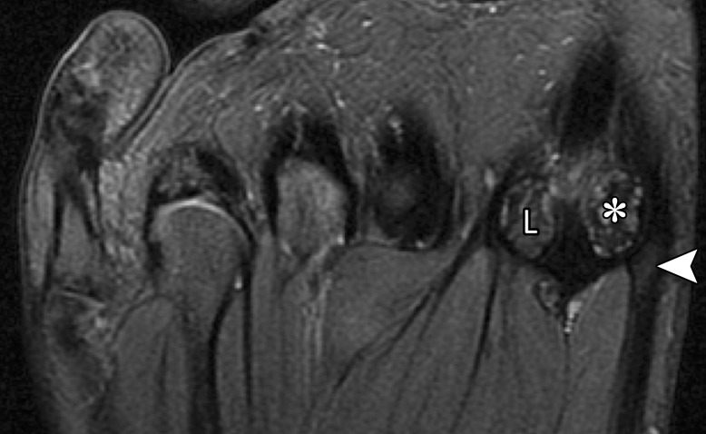 Medial MTSL tear in a 21-year-old man. Coronal (a) and axial (b) T2-weighted FS images show mild chondral loss (*) at the medial sesamoid and metatarsal head articulation. Partial tearing of the medial MTSL and capsular structures is seen with a fluid cleft at the sesamoid insertion (arrow). Thickening and altered signal intensity of the medial head of the FHB and abductor hallucis tendons (arrowhead) is compatible with tendinosis. These medial plantar structures interlink to prevent hallux valgus. L = lateral sesamoid, MT = first metatarsal.