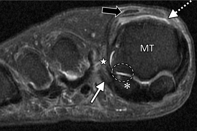 Lateral MTSL tear in a 54-year-old woman with right hallux valgus and first web space pain. Coronal T2-weighted FS (a) and PDW (b) images show chondral loss at the lateral sesamoid (*) and first metatarsal articulation (dashed oval). There is partial tearing of the lateral MTSL (☆) with adjacent first web space edema and adductor hallucis tendinosis (solid white arrow). Medial sagittal band tearing (dotted arrow) and mild lateral subluxation of the extensor tendons (black arrow) are due to underlying hallux valgus. There is atrophy of the abductor hallucis and the FHB muscles (arrowheads) due to long-standing hallux valgus deformity. f = flexor hallucis longus tendon, MT = first metatarsal.