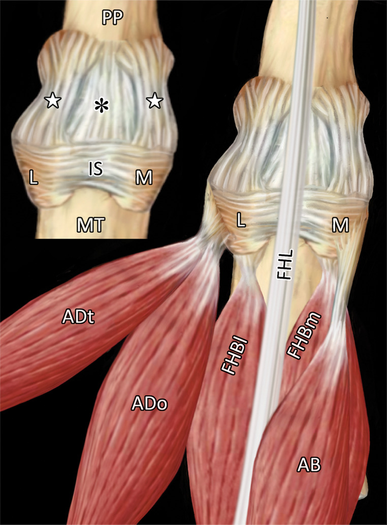 First MTPJ anatomy. (a) Drawing depicts a view from below the first MTPJ musculotendinous structures. Laterally, the oblique (ADo) and transverse (ADt) heads of the adductor hallucis provide resistance to medial displacement. Medially, the abductor hallucis tendon (AB) inserts at the medial sesamoid (M) and medial capsuloligamentous structures, preventing hallux valgus. The lateral (FHBl) and medial (FHBm) heads of the FHB insert at the respective sesamoids, preventing distal sesamoid migration. Inset in a shows the MTPJ with the FHL and tendons removed. IS = intersesamoid ligament. (b, c) Gross anatomy of a cadaveric first MTPJ specimen (b) is also shown with the medial structures dissected and then with plantar disarticulation, with the plantar plate complex (c) viewed from the dorsal aspect. Paired SPLs (☆) and the medial SPL (arrow in b) are continuous with the capsule and fibrocartilaginous pad (*), preventing proximal sesamoid migration. The ISL (dotted line in c) prevents sesamoid splaying. Chondral defects are noted at the metatarsal head (arrowheads in c). L = lateral sesamoid, MT = metatarsal, PP = proximal phalanx.