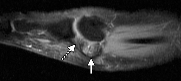 Bipartite sesamoiditis. (a–c) Axial (a) and sagittal T2-weighted FS (b) and sagittal (c) PDW images show medial sesamoiditis in a 24-year-old woman with pain at the plantar aspect of the right first MTPJ. There is a bifid appearance of the medial sesamoid with marrow edema (solid arrow in a and b) at both components. Smooth corticated margins and the presence of a waist at the superior margin of the sesamoid (arrow in c) are more suggestive of bipartite sesamoiditis rather than a fracture. Partial tearing of the medial SPL is also seen (dotted arrow). Radiographs were not available in this patient but are useful for assessment and follow-up. L = lateral sesamoid. (d, e) Dorsoplantar (d) and lateral (e) radiographs in a 15-year-old patient with plantar trauma show separation of two components at the medial sesamoid (dashed circles). This was a challenging case, with the proximal rounded margins of the distal component (arrowhead) suggestive of diastasis of a bipartite sesamoid rather than a fracture. Despite the challenges in differentiating the two conditions, fracture and diastasis are treated similarly with initial conservative management.