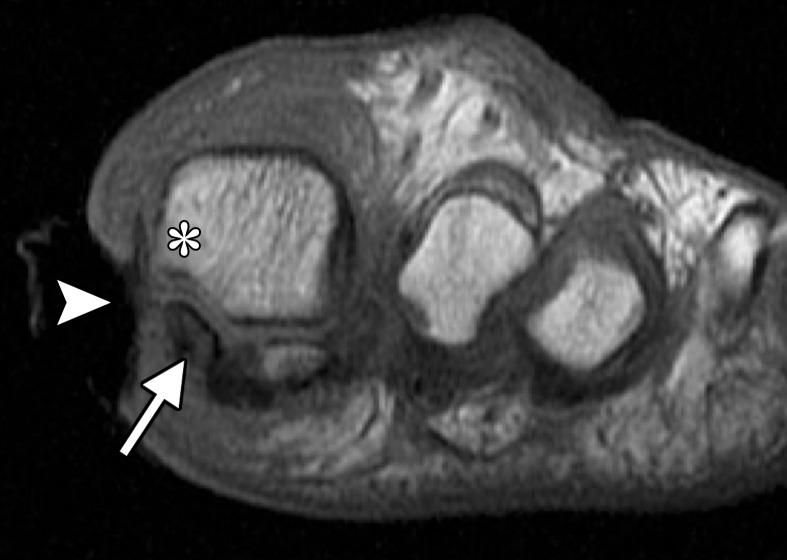 Methicillin-resistant Staphylococcus aureus (MRSA) osteomyelitis at the first MTPJ in a 70-year-old woman with a diabetic wound at the medial first toe. Coronal T1-weighted (a) and T2-weighted (b) FS images show a large soft-tissue ulcer along the medial aspect of the first MTPJ (arrowhead). There is irregularity and loss of the normal T1-weighted marrow signal at the medial sesamoid (arrow) with edema at the sesamoid and medial metatarsal head (*). These changes are suspicious for osteomyelitis. Soft-tissue swelling and edema around the first digit with a small first MTPJ effusion are also noted.