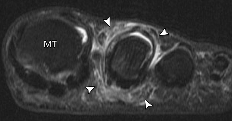 Collateral ligament tears and predislocation syndrome. Axial PDW (a) and coronal T2-weighted FS (b) images show hallux valgus with partial tears of the medial (solid arrow) and lateral (dotted arrow) collateral ligaments with first MTPJ degenerative changes. Capsular thickening and surrounding edema (arrowheads) are seen at the second MTPJ. These imaging features are consistent with adhesive capsulitis, which in association with hallux valgus is termed predislocation syndrome. As the name implies, if the underlying biomechanical abnormality is not corrected, the second MTPJ plantar plate will tear, resulting in instability and eventual dislocation. MT = first metatarsal.