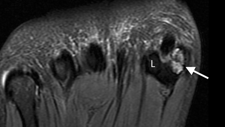 Sesamoid fracture. (a, b) Medial sesamoid fracture in a 32-year-old man after a fall. Axial T2-weighted FS (a) and sagittal PDW (b) images show an irregular cleft through the medial sesamoid with edema at the bony fragments and mild displacement likely caused by a fracture (solid white arrow). An intact medial SPL is apparent (dotted arrow). Differentiating a bipartite sesamoid from a fracture can be challenging. Irregular margins, displacement of the bony components, and a clear history of trauma are more suggestive of a fracture. Radiographs can be useful in assessment and follow-up, but radiographs were not available in this patient. L = lateral sesamoid. (c) Dorsoplantar radiograph in a 49-year-old woman with trauma to the medial sesamoid shows a cleft at the medial sesamoid with slightly irregular margins and no rounded waist (dashed circle). These imaging features are more suggestive of a fracture. (d, e) Dorsoplantar radiograph (d) obtained at 1-year follow-up and axial CT image (e) show interval osseous bridging due to healing. (f) Medial oblique radiograph in a 24-year-old woman shows an irregular fracture of the proximal lateral sesamoid (arrowhead) associated with a dislocation at the first MTPJ due to a motor vehicle accident.