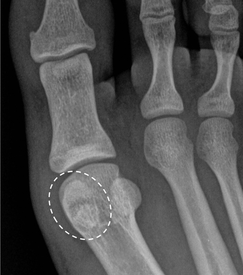 Bipartite sesamoiditis. (a–c) Axial (a) and sagittal T2-weighted FS (b) and sagittal (c) PDW images show medial sesamoiditis in a 24-year-old woman with pain at the plantar aspect of the right first MTPJ. There is a bifid appearance of the medial sesamoid with marrow edema (solid arrow in a and b) at both components. Smooth corticated margins and the presence of a waist at the superior margin of the sesamoid (arrow in c) are more suggestive of bipartite sesamoiditis rather than a fracture. Partial tearing of the medial SPL is also seen (dotted arrow). Radiographs were not available in this patient but are useful for assessment and follow-up. L = lateral sesamoid. (d, e) Dorsoplantar (d) and lateral (e) radiographs in a 15-year-old patient with plantar trauma show separation of two components at the medial sesamoid (dashed circles). This was a challenging case, with the proximal rounded margins of the distal component (arrowhead) suggestive of diastasis of a bipartite sesamoid rather than a fracture. Despite the challenges in differentiating the two conditions, fracture and diastasis are treated similarly with initial conservative management.