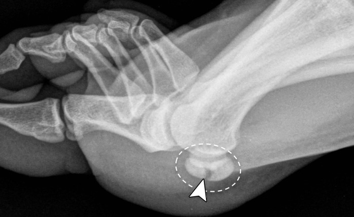 Bipartite sesamoiditis. (a–c) Axial (a) and sagittal T2-weighted FS (b) and sagittal (c) PDW images show medial sesamoiditis in a 24-year-old woman with pain at the plantar aspect of the right first MTPJ. There is a bifid appearance of the medial sesamoid with marrow edema (solid arrow in a and b) at both components. Smooth corticated margins and the presence of a waist at the superior margin of the sesamoid (arrow in c) are more suggestive of bipartite sesamoiditis rather than a fracture. Partial tearing of the medial SPL is also seen (dotted arrow). Radiographs were not available in this patient but are useful for assessment and follow-up. L = lateral sesamoid. (d, e) Dorsoplantar (d) and lateral (e) radiographs in a 15-year-old patient with plantar trauma show separation of two components at the medial sesamoid (dashed circles). This was a challenging case, with the proximal rounded margins of the distal component (arrowhead) suggestive of diastasis of a bipartite sesamoid rather than a fracture. Despite the challenges in differentiating the two conditions, fracture and diastasis are treated similarly with initial conservative management.