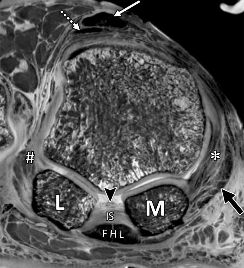 First metatarsosesamoid joint anatomy in a cadaveric specimen. Coronal gradient-echo image (5000/10) shows how the paired lateral (#) and medial (*) MTSLs secure the lateral (L) and medial (M) sesamoids. These ligaments form a plantar plate complex along with the joint capsule, intersesamoid ligament (IS), and musculotendinous structures, including the abductor hallucis muscle and tendon (black arrow). The fibers of the ISL are intimately associated with the FHL tendon sheath and a deep synovial fold (arrowhead). At the dorsal first MTPJ, the EHB (dotted arrow) lies deep and slightly lateral to the EHL (white arrow).