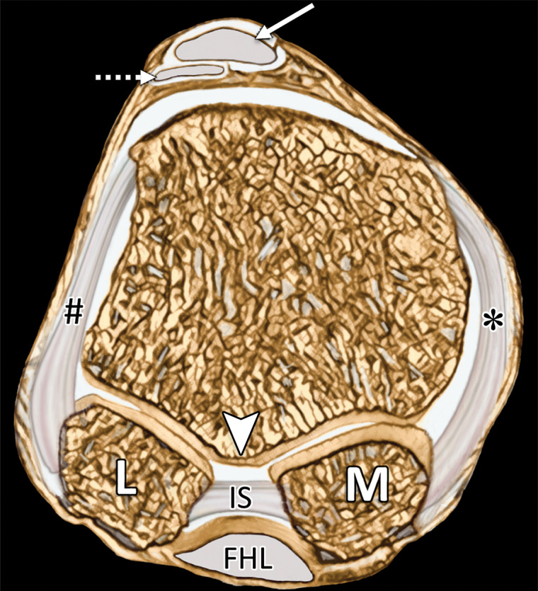 First MTPJ anatomy. Sagittal (a) and coronal cross-sectional (b) drawings (plane in b represented by the dotted line in a) show how the medial SPL (★), lateral SPL (not shown), and lateral (#) and medial (*) MTSLs secure the lateral (L) and medial (M) sesamoids. These ligaments form a plantar plate complex with the joint capsule, ISL, and musculotendinous structures. At the dorsal first MTPJ, the EHB (dotted arrow) attaches to the proximal phalanx (PP) and lies deep and slightly lateral to the EHL (solid arrow). The first metatarsal crest (arrowhead in b) is shown between the grooved sesamoid facets. FHL = flexor hallucis longus, IS = intersesamoid ligament, MT = metatarsal.