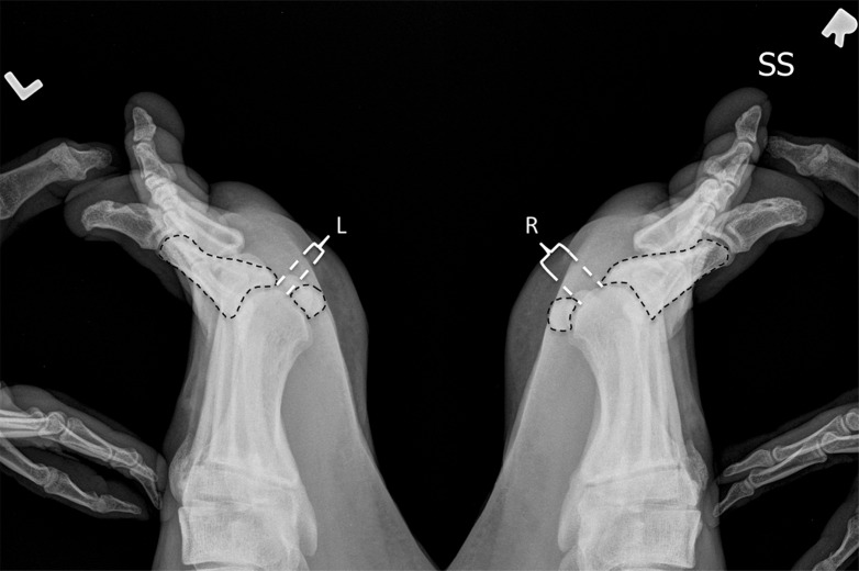 Turf toe in a 28-year-old professional American football player. Arrowheads = FHL, MT = first metatarsal. (a) Sagittal PDW FS image of the right first MTPJ shows complete tearing of the medial SPL (arrow). Additional high-grade tearing of the lateral SPL was apparent (not shown). PP = first proximal phalanx. (b, c) Coronal PDW FS images of the lateral (L) and medial (M) sesamoids (b) and just distal to the sesamoids (c) show the medial SPL tear extending into the ISL (★) and central plantar plate (*). Partial tearing of the medial MTSL (dotted arrow) is also seen. (d) Lateral dynamic dorsiflexed radiograph of both feet shows increased proximal migration of the right medial sesamoid compared to the left medial sesamoid. The medial sesamoids and proximal phalanges are outlined (dashed lines).