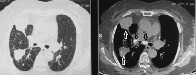 Bronchial Anthracosis: A New Diagnosis for Benign Mass Lesions of the ...