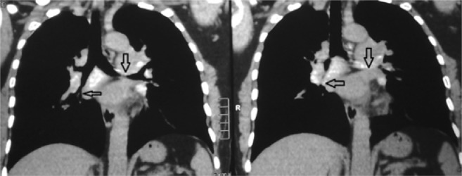 Bronchial Anthracosis: A New Diagnosis for Benign Mass Lesions of the ...