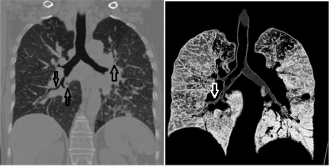 Bronchial Anthracosis: A New Diagnosis for Benign Mass Lesions of the ...