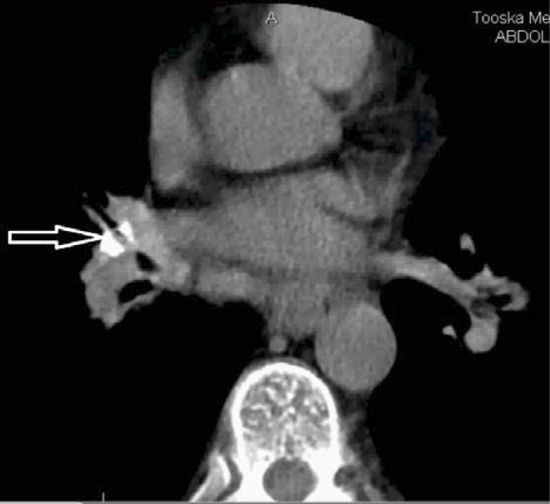 Bronchial Anthracosis: A New Diagnosis for Benign Mass Lesions of the ...