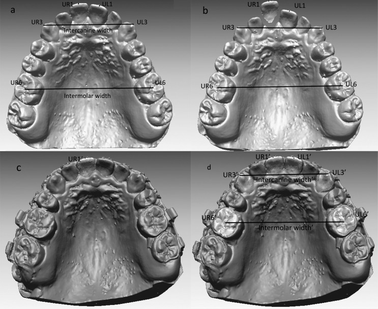 Figure 4. (a) The measuring points on T1 scan (in blue; please see the online version for color). UR1 indicates the midpoint on the edge of maxillary right central incisor; UL1, midpoint on the edge of maxillary left central incisor; UR3, tip of maxillary right canine; UL3, tip of maxillary left canine; UR6, fovea of right maxillary first molar; UL6, fovea of maxillary left first molar; intercanine width, distance between UR3 and UL3; intermolar width, distance between UR6 and UL6. (b) The maxillary right central incisor was detached from the T1 scan. (c) UR1 fixed on the maxillary right central incisor on the T1 scan was transferred into the maxillary right central incisor on the T3 scan (in red) with the three-dimensional image registration technique. (d) The measuring points on the T1 scan were transferred into the corresponding teeth on the T3 scan, respectively.