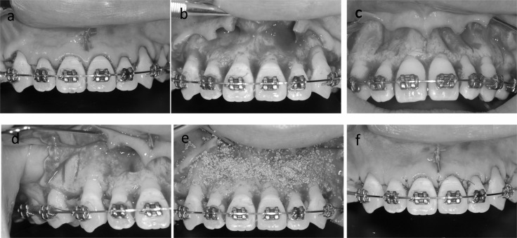 Figure 1. (a) Sulcular incision performed on the anterior teeth area. (b) Reflection of full-thickness flap. (c, d) Interradicular alveolar corticotomy grooves with piezosurgery. (e) Bone graft material filled the corticotomy area. (f) Flap was sutured.