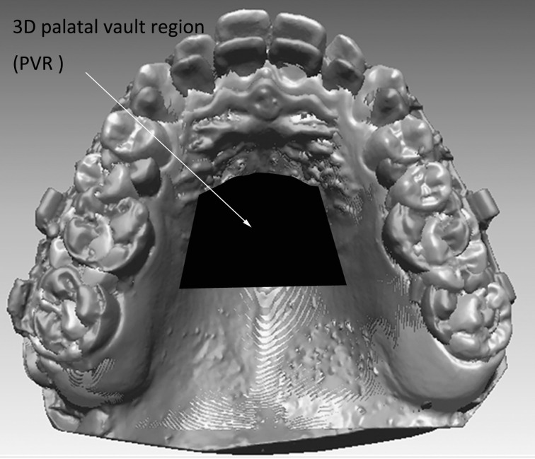 Figure 3. Superimposition of maxillary digital casts of T1 (in blue; please see the online version for color) and T3 (in red) on the three-dimensional palatal vault region.