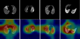 Representative slices corresponding to Grad-CAM images on the test
set.