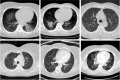 Representative cases that the majority of radiologists misclassified.
A-C (top row, left to right): COVID-19 pneumonia. Our model correctly
classified all three cases. A. 4/6 radiologists (radiologists 3-6) said it
was non-COVID-19. With AI assistance, 2/6 radiologists (radiologists 5 and
6) continued to say it was non-COVID-19. B. 4/6 radiologists (radiologists
3-6) said it was non-COVID-19. With AI assistance, 3/6 radiologists
(radiologists 3-5) continued to say it was non-COVID-19. C. 4/6 radiologists
(radiologists 2 and 4-6) said it was non-COVID-19. With AI assistance, 1/6
radiologist (radiologist 2) continued to say it was non-COVID-19. D-F
(bottom row, left to right): Non-COVID-19 pneumonia. Our model correctly
classified D and E. D. 5/6 radiologists (radiologists 1-5) said it was
COVID-19. With AI assistance, all 5/6 radiologists continued to say it was
COVID-19. E. 4/6 radiologists (radiologists 1, 2, 4, and 6) said it was
COVID-19. With AI assistance, 3/6 radiologists (radiologists 1, 2, and 4)
continued to say it was COVID-19. F. 4/6 radiologists (radiologists 1-3 and
6) said it was COVID-19. With AI assistance, 5/6 radiologists (radiologists
1-4 and 6) said it was COVID-19.