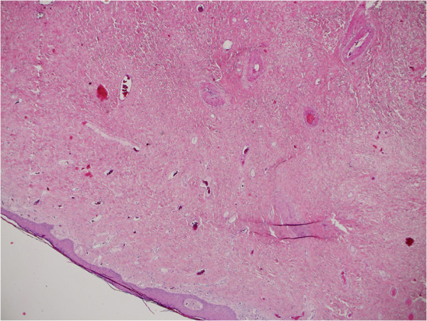 Giant fibroepithelial stromal polyp of the vulva: largest case reported ...