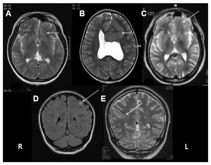 Focal cortical dysplasia and epilepsy surgery pmc