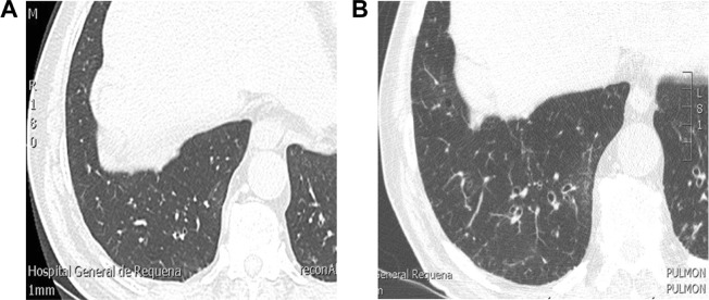 Bronchiectasis in COPD patients: more than a comorbidity? - PMC