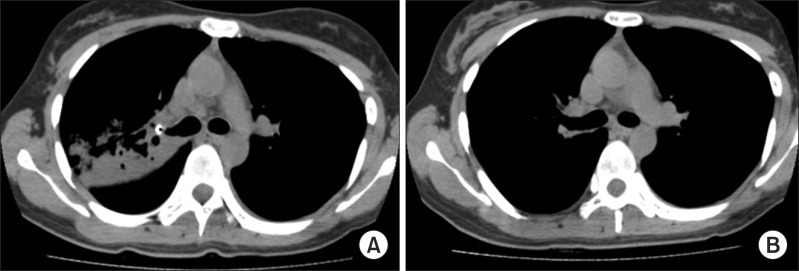 A Promising Treatment for Broncholith Removal Using Cryotherapy during ...