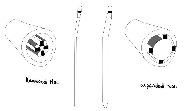 Figure 2. Illustration of Fixion IMN – a cross-section of a long bone pre-and post-expansion19