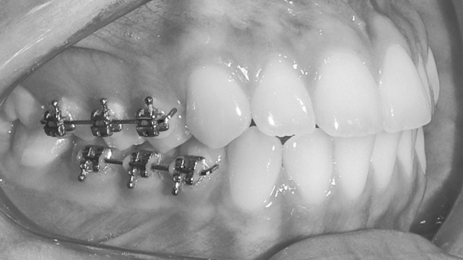 Figure 1. Intraoral view of randomized split-mouth grouping.