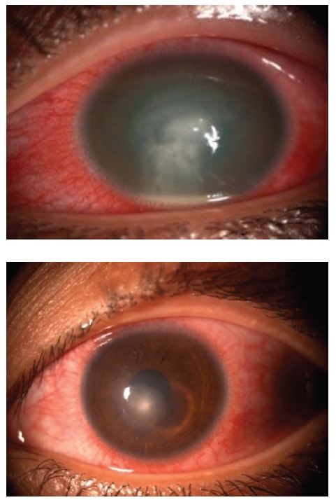 Figure 2: Central corneal ulcer with dense infiltrates and hypopyon (top), which healed with paracentral scar (bottom)