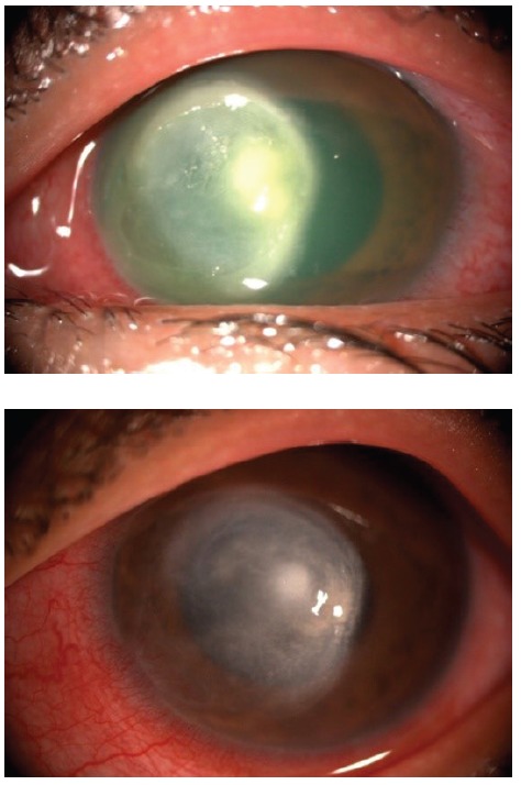 Figure 1: Large central corneal ulcer encroaching limbus nasally with dense stromal infiltrates (top), resulting in dense scar once healed (bottom)