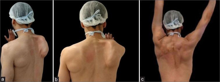 Thoracodorsal to long thoracic nerve transfer in a patient with ...