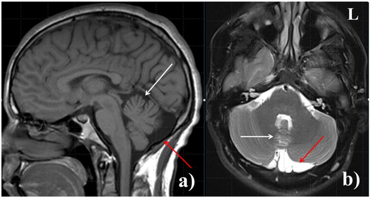 Whole-exome sequencing as a diagnostic tool in a family with episodic ...